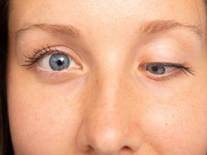 علاج انحراف العين